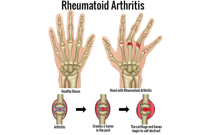 Homeopathic remedies Upper Respiratory Infections