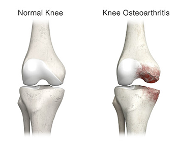 Chronic kidney disease homeopathy in Pammal