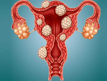 homeopathic treatment for gallstones in Pammal