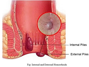homoeopathy treatment for hepatomegaly in Pammal